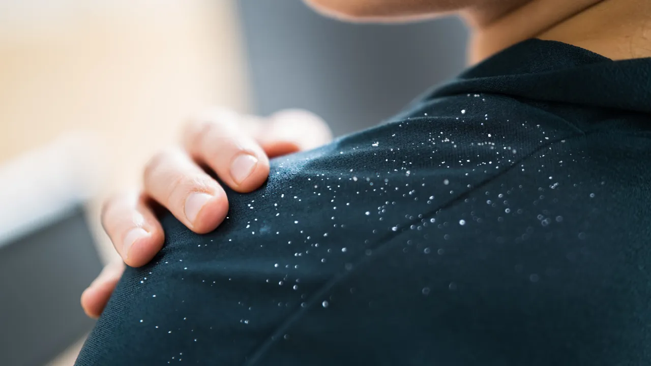 10 แชมพูขจัดรังแค ยี่ห้อไหนดี ช่วยขจัดรังแคและลดอาการคันหนังศีรษะ