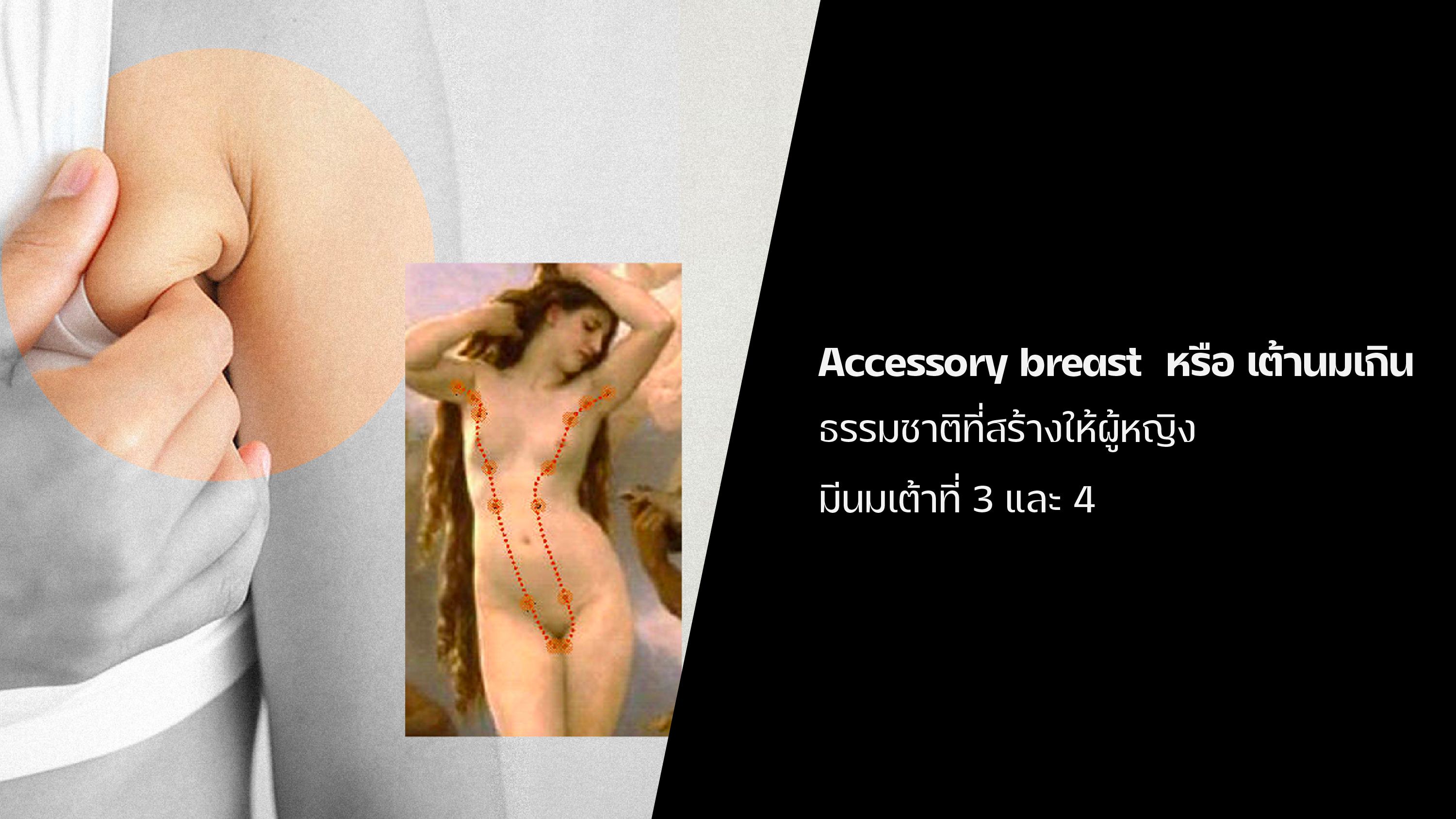 Accessory breast  หรือ เต้านมเกิน  ธรรมชาติที่สร้างให้ผู้หญิงมีนมเต้าที่ 3 และ 4 